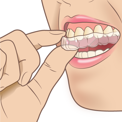 [歯のホワイトニング] オススメの種類、治療の流れ、値段について